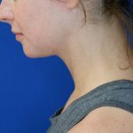 after submental chin liposuction left downward side view of female patient 4568