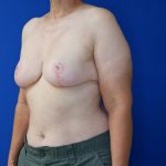 after breast reduction and lift left angle view of female patient 4642