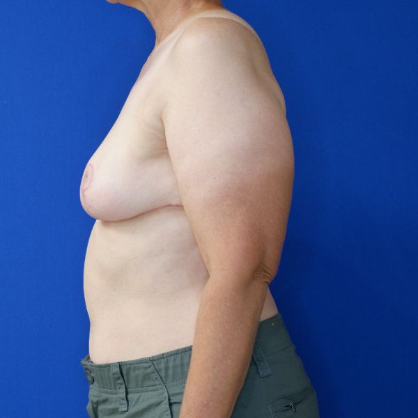 after breast reduction and lift left side view of female patient 4642