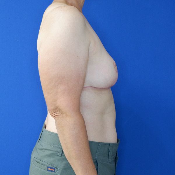 after breast reduction and lift right side view of female patient 4642