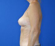 after breast revision left side view of female patient 4631
