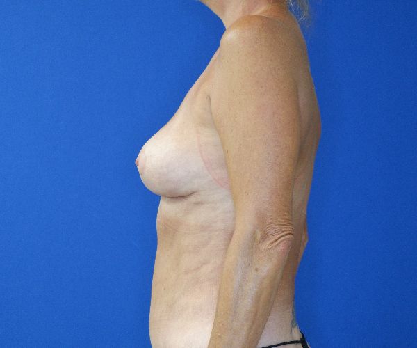 after breast revision left side view of female patient 4631