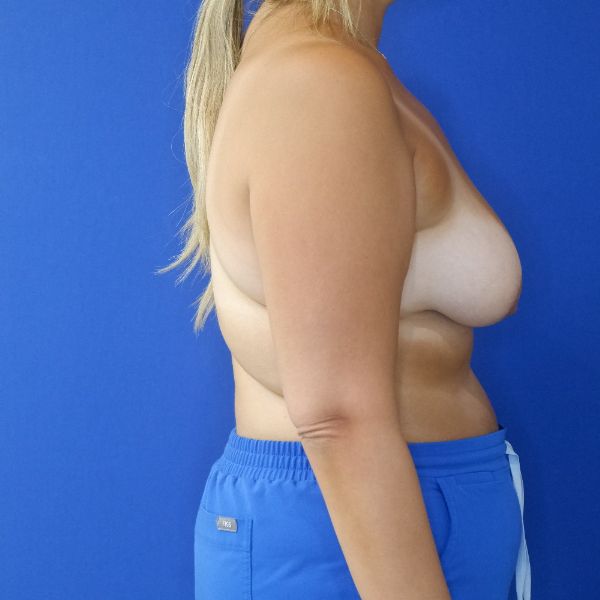before breast lift with augmentation right side view of female patient 4757