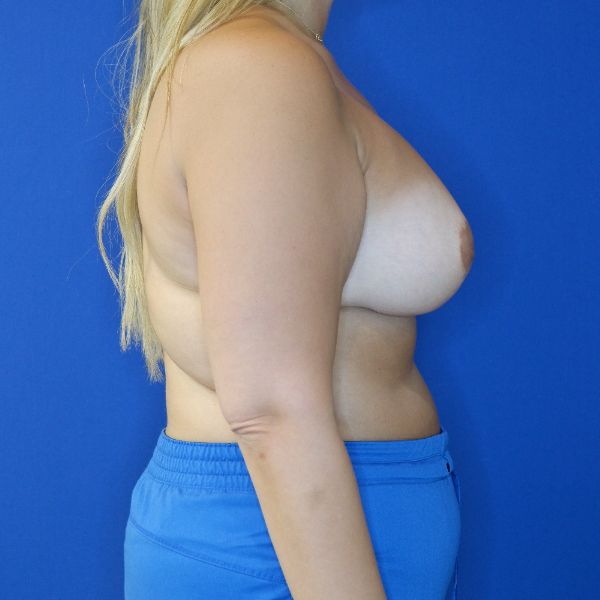 after breast lift with augmentation right side view of female patient 4757
