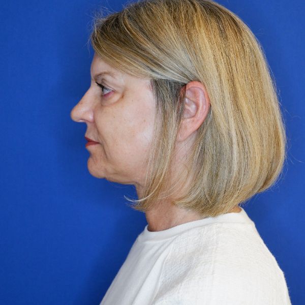 after facelift and neck lift left side view of female patient looking forward 4768