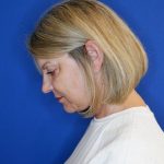 after facelift and neck lift left side view of female patient looking downward 4768
