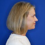 after facelift and neck lift right side view of female patient looking forward 4768