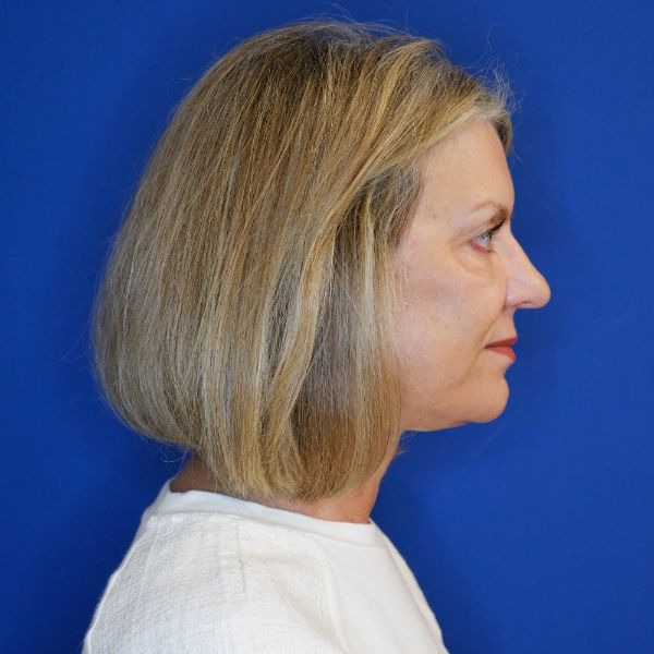 after facelift and neck lift right side view of female patient looking forward 4768