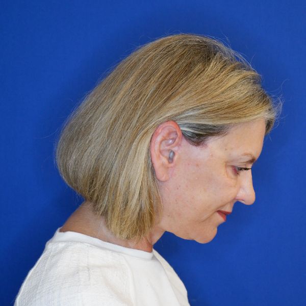 after facelift and neck lift right side view of female patient looking downward 4768