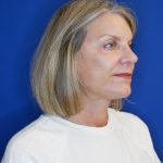 after facelift and neck lift right angle view of female patient 4768