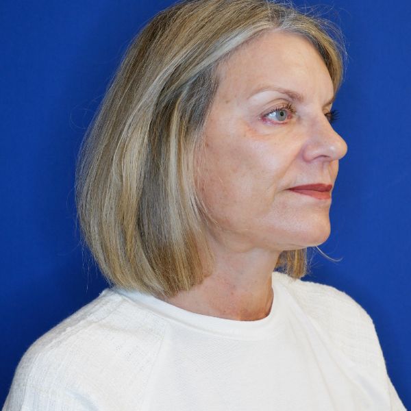 after facelift and neck lift right angle view of female patient 4768