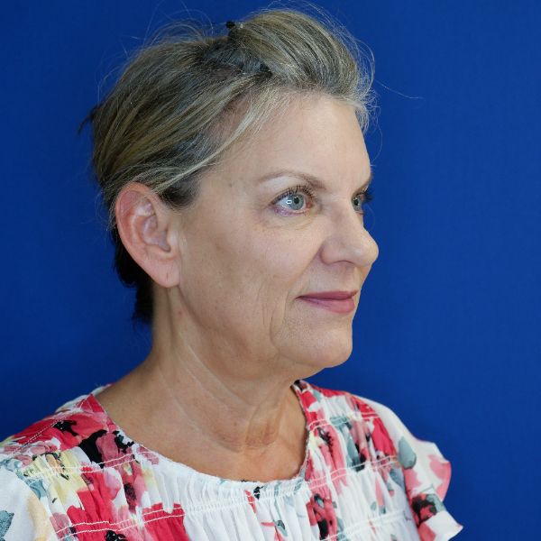 before facelift and neck lift right angle view of female patient 4768