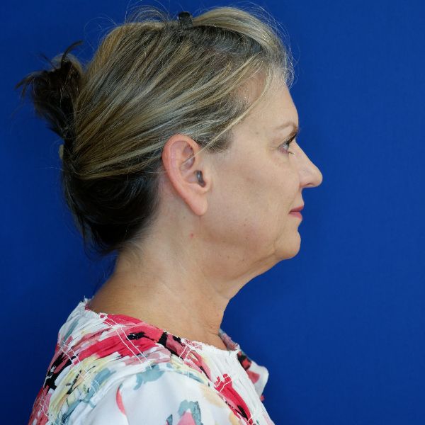 before facelift and neck lift right side view of female patient looking forward 4768