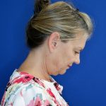 before facelift and neck lift right side view of female patient looking downward 4768