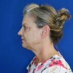 before facelift and neck lift left side view of female patient looking forward 4768