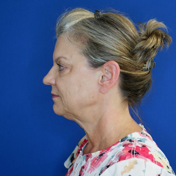 before facelift and neck lift left side view of female patient looking forward 4768
