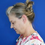 before facelift and neck lift left side view of female patient looking downward 4768