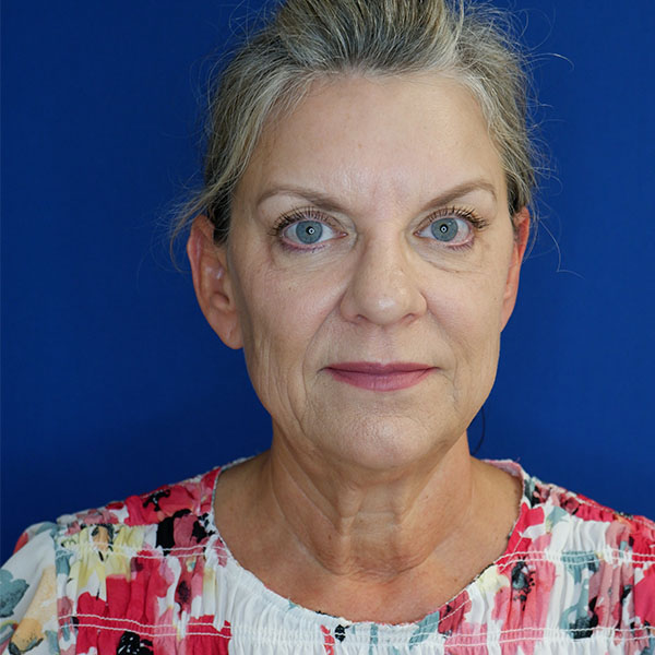 before facelift and neck lift front view of female patient 4768