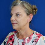 before facelift and neck lift left angle view of female patient 4768