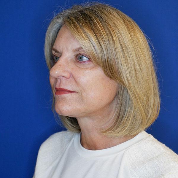 after facelift and neck lift left angle view of female patient 4768