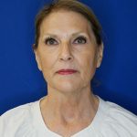 before facelift neck lift front view of female patient 5080