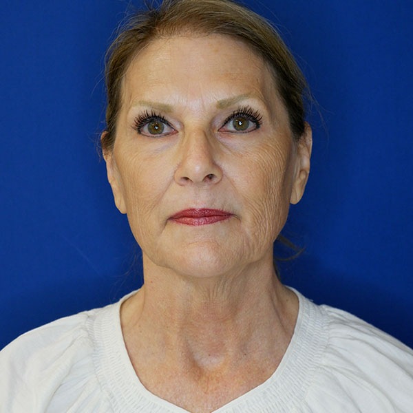 before facelift neck lift front view of female patient 5080