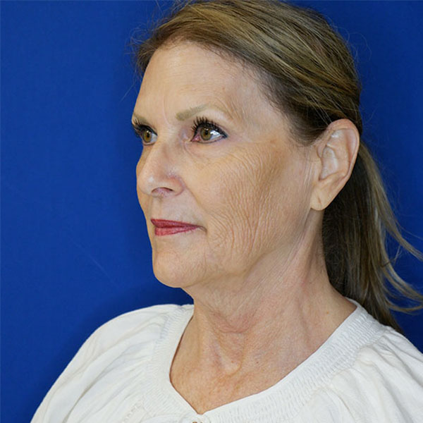 before facelift neck lift left angle view of female patient 5080