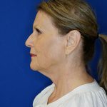 before facelift neck lift left side view of female patient 5080