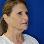 before facelift neck lift right angle view of female patient 5080