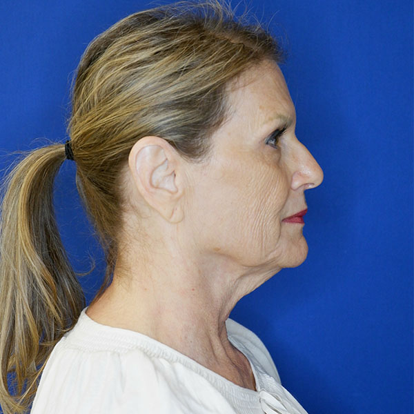 before facelift neck lift right side view of female patient 5080