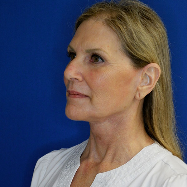 after facelift neck lift left angle view of female patient 5080