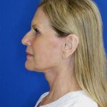 after facelift neck lift left side view of female patient 5080