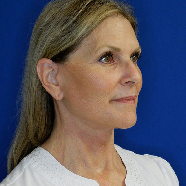 after facelift neck lift right angle view of female patient 5080