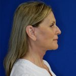 after after facelift neck lift right side view of female patient 5080