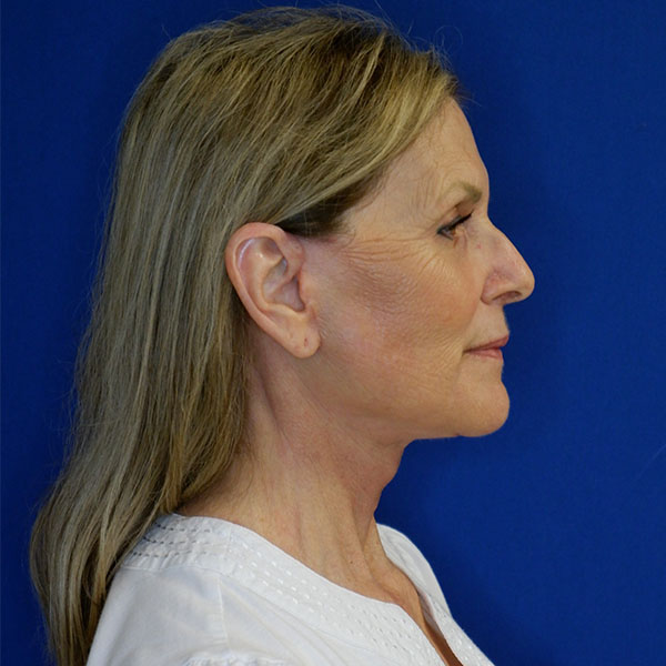 after after facelift neck lift right side view of female patient 5080