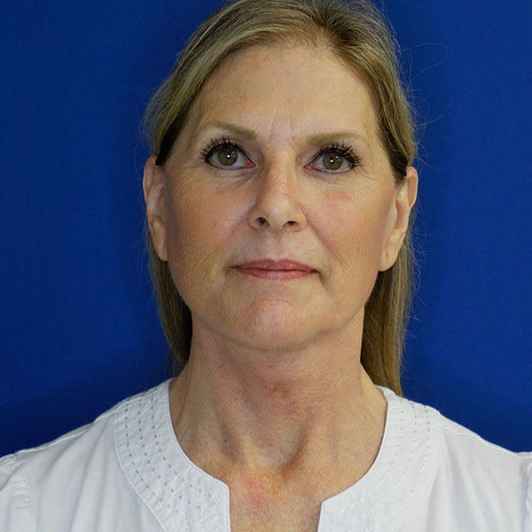 after facelift neck lift front view of female patient 5080